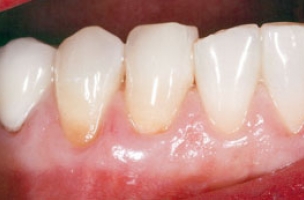 gum-disease-after