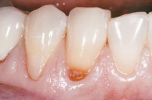 gum-disease-before