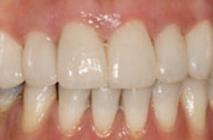 porcelain-veneers-after