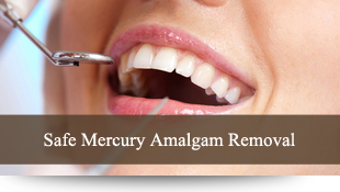 Sae Mercury Amalgam Removal